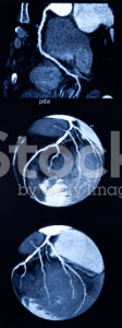 stock-photo-9090252-coronary-angiography