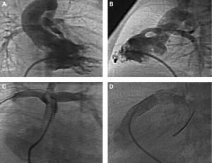 cardiovascular intervention